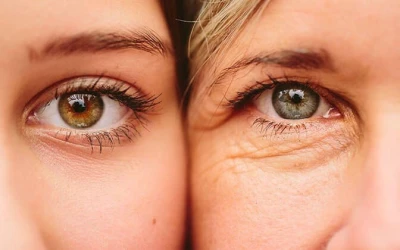 Phẫu Thuật Cắt Da Thừa Mí Mắt ( Mí trên/Mí dưới)