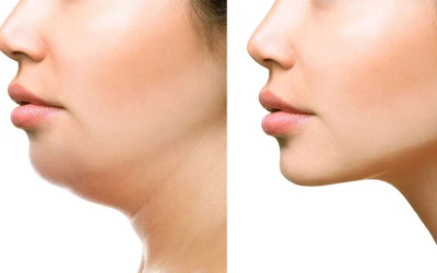 Hút Mỡ Cằm