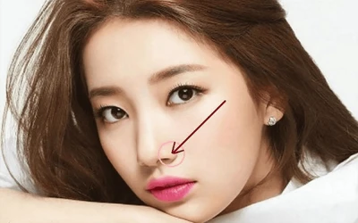 Phẫu Thuật Thu Gọn Cánh Mũi