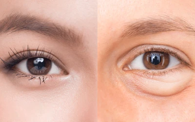 Phẫu Thuật Lấy Bọng Mỡ Mí Mắt ( Mí trên/ Mí Dưới)