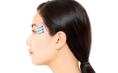 Phẫu Thuật Căng Da Thái Dương