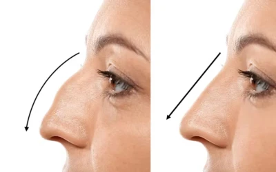 Phẫu Thuật Chỉnh Hình Mũi Gồ