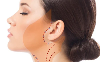 Phẫu Thuật Căng Da Mặt Bán Phần