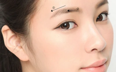Phẫu Thuật Treo Cung Mày